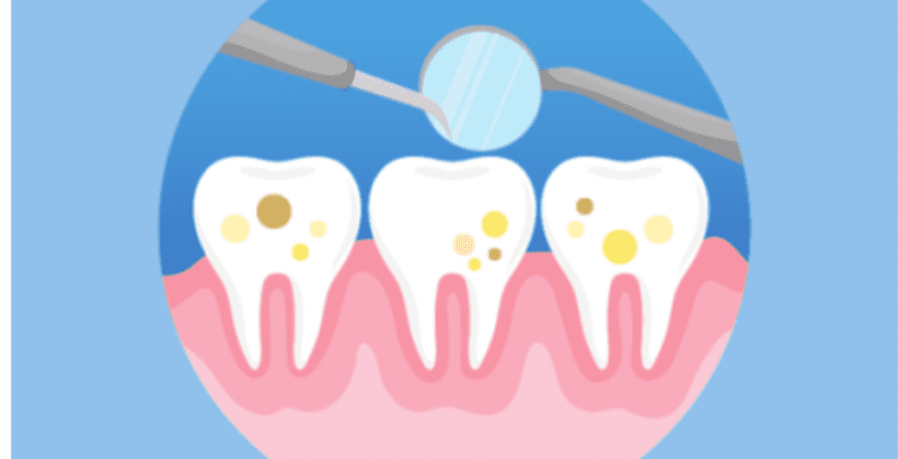 Teeth mottling – Krishees Dental