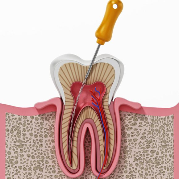 Root Canal