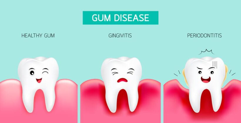 Gum Disease Unveiled: Symptoms, Stages, and Steps to Healthy Gums