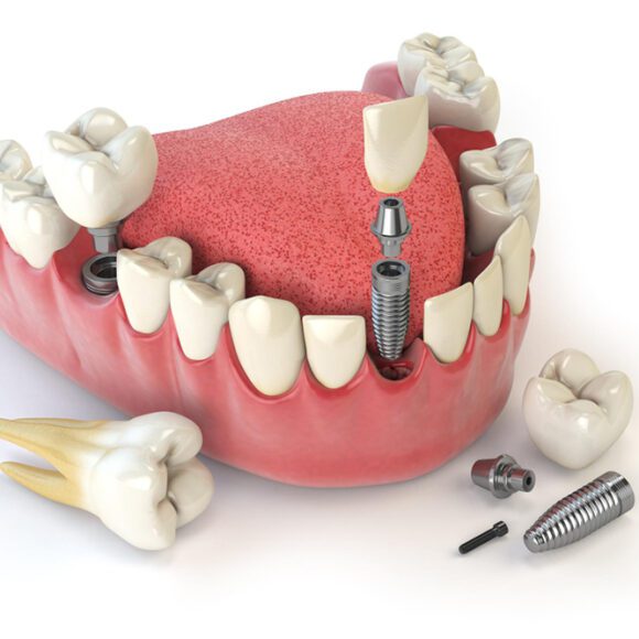 Teeth Crowns & Bridges