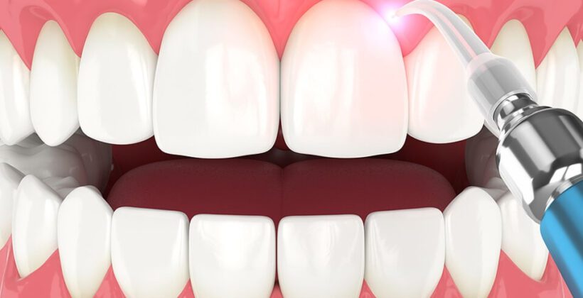 Why Everyone’s Talking About Laser Gum Therapy