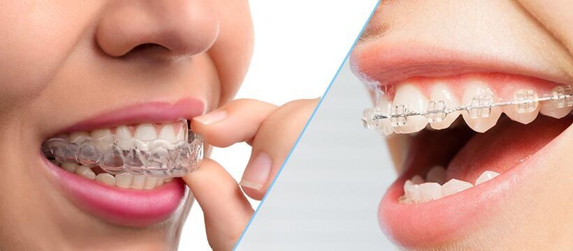Invisalign vs braces