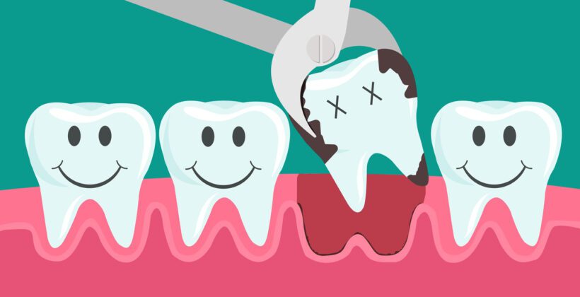 Tooth Extraction