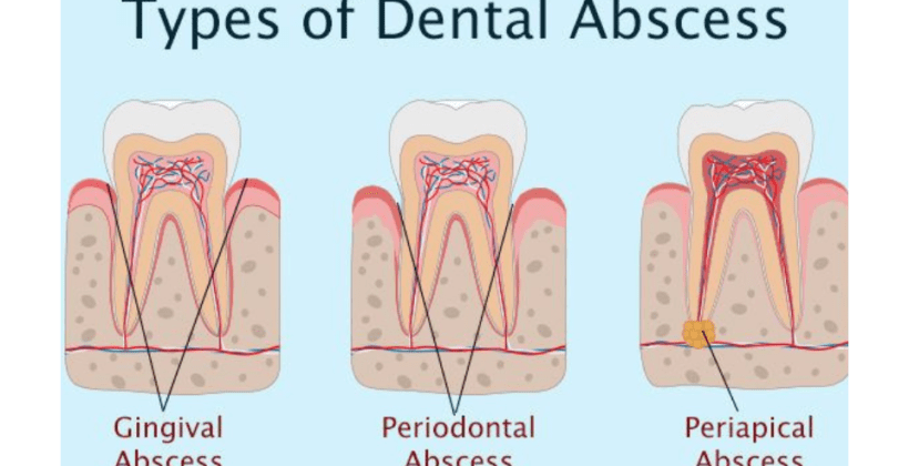 Dental abscesses