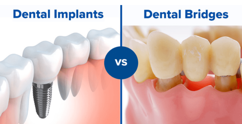 Revolutionizing Your Smile: The Ultimate Guide to Dental Bridges vs. Implants