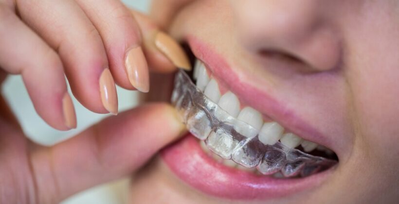 Beyond Braces: How Dental Bonding Can Reshape Your Perfect Smile