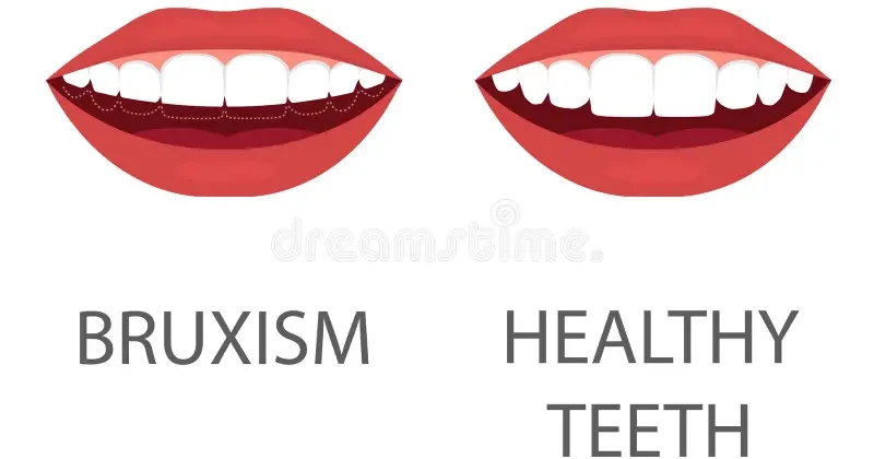 Beyond the Grind: Holistic Solutions for Bruxism Troubles