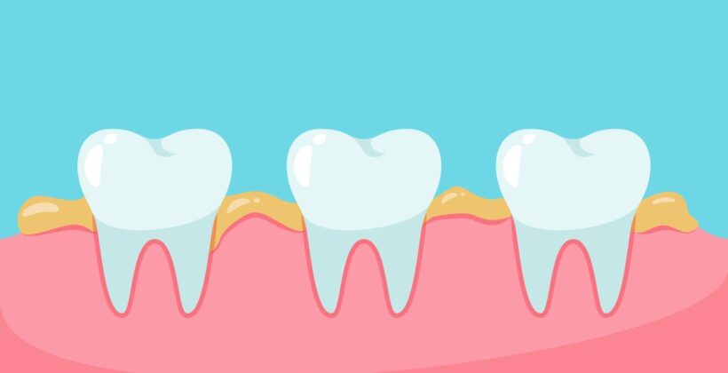 What is a Dental Plaque?