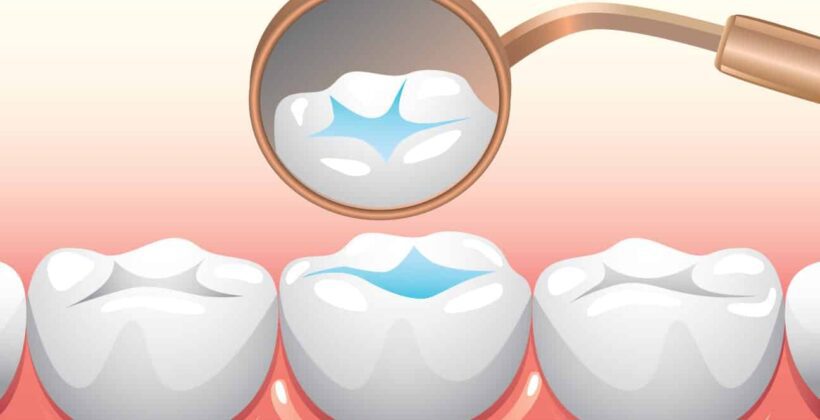 Guardians of Your Smile: The Marvels of Dental Sealants