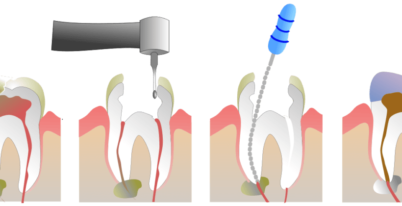 Tooth eruption