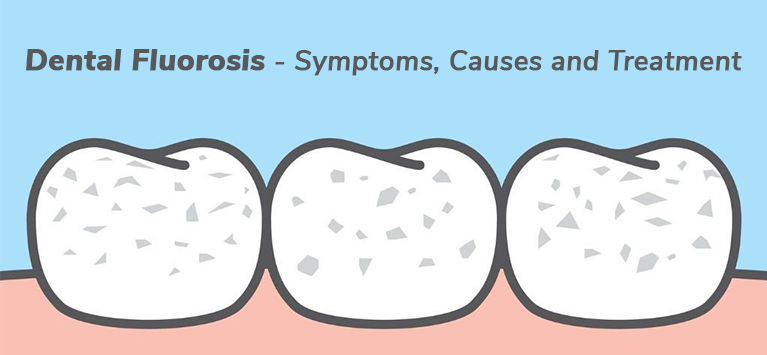 Understanding Dental Fluorosis