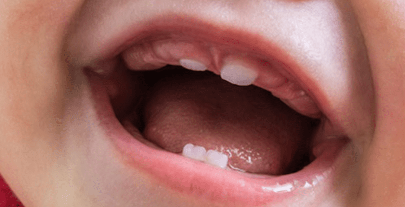 Deciduous Teeth and Speech Development: Connecting the Dots