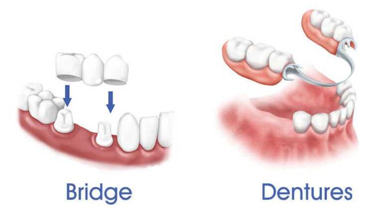 Removable Partial Denture