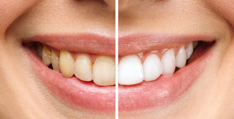 Yellow Teeth: Treatment Tips from Krishees Dental Yellow Teeth: Treatment Tips from Krishees Dental