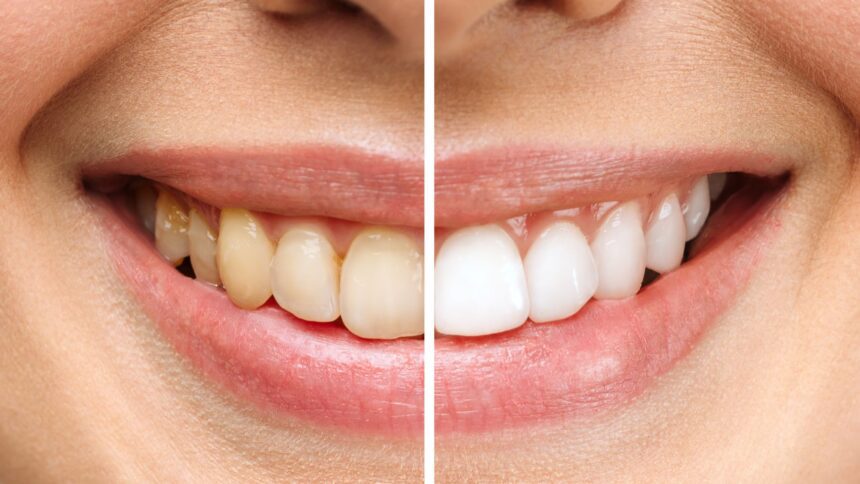 Yellow Teeth: Treatment Tips from Krishees Dental